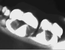 Load image into Gallery viewer, Dexis CariVu Dental Transillumination Portable Caries Detection Device