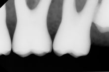 Load image into Gallery viewer, Denttio Tio-H Dental Intraoral X-Ray Sensor Size 1