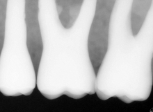 Load image into Gallery viewer, Carestream RVG 6100 Dental Sensor Size 1