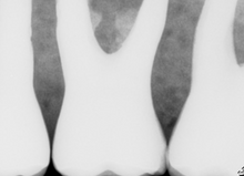 Load image into Gallery viewer, Schick CDR Elite Dental Imaging Sensor Size 0