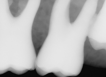 Load image into Gallery viewer, Sirona Schick 33 Dental Intraoral X-Ray Sensor Size 0