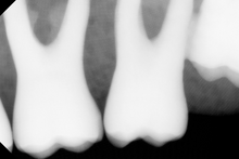 Load image into Gallery viewer, Dentimax Dream Dental Intraoral X-Ray Sensor Size 1