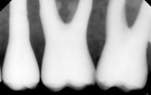 Load image into Gallery viewer, Gendex eHD Visualix Dental Imaging Sensor Size 1