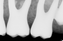 Load image into Gallery viewer, Schick CDR Elite Dental Digital Imaging Sensor Size 1