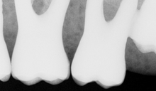 Load image into Gallery viewer, Schick CDR Elite Dental Digital Imaging Sensor Size 1