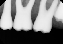 Load image into Gallery viewer, Tuxedo Imaging LLC Dental Intraoral X-Ray Sensor Size 2