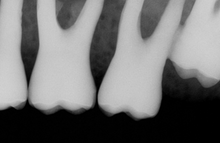 Load image into Gallery viewer, XDR Dental Intraoral X-Ray Sensor Size 1