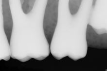 Load image into Gallery viewer, Sirona Schick 33 Dental Intraoral X-Ray Sensor Size 1
