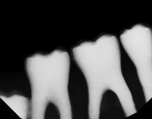Load image into Gallery viewer, Dexis Titanium Digital Dental Intraoral X-Ray Sensor Size 2
