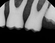 Load image into Gallery viewer, Dexis Titanium Digital Dental Intraoral X-Ray Sensor Size 2
