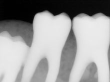 Load image into Gallery viewer, Kodak RVG 6100 Dental Intraoral X-Ray Sensor Size 1
