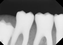 Load image into Gallery viewer, Dentimax Dream Dental Intraoral X-Ray Sensor Size 2
