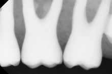 Load image into Gallery viewer, Dentimax Dream Dental Intraoral X-Ray Sensor Size 1
