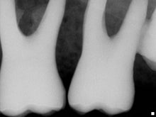 Load image into Gallery viewer, Schick CDR Elite Dental Intraoral X-Ray Sensor Size 2
