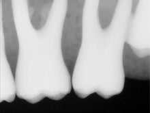 Load image into Gallery viewer, Kodak RVG 6100 Dental Intraoral X-Ray Sensor Size 1
