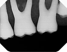 Load image into Gallery viewer, Dexis Platinum Dental Intraoral X-Ray Sensor Size 2 SOLD AS IS
