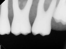 Load image into Gallery viewer, Carestream RVG 6200 Dental Intraoral X-Ray Sensor Size 2
