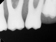 Load image into Gallery viewer, Carestream RVG 6200 Dental Intraoral X-Ray Sensor Size 2
