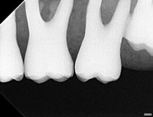 Load image into Gallery viewer, Acteon SoPix 2 Dental Intraoral X-Ray Sensor Size 2
