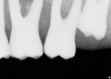 Load image into Gallery viewer, Sirona Schick CDR Elite Dental Intraoral X-Ray Sensor Size 2
