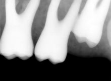 Load image into Gallery viewer, Suni SuniRay2 Dental Intraoral X-Ray Sensor Size 2
