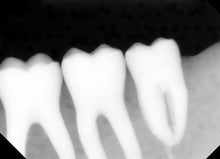 Load image into Gallery viewer, Tuxedo Digital Imaging Intraoral X-Ray Sensor Size 2
