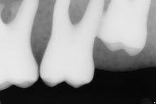 Load image into Gallery viewer, Sirona Schick 33 Dental Intraoral X-Ray Sensor Size Size 1
