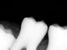 Load image into Gallery viewer, Sirona Schick CDR Elite Dental Intraoral X-Ray Sensor Size 2
