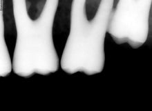 Load image into Gallery viewer, Suni SuniRay 2 Dental Intraoral X-Ray Sensor Size 2
