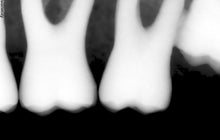 Load image into Gallery viewer, Suni SuniRay 2 Dental Intraoral X-Ray Sensor Size 1
