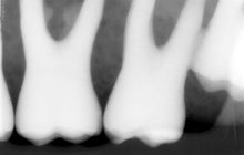 Load image into Gallery viewer, Suni SuniRay 2 Dental Intraoral X-Ray Sensor Size 1
