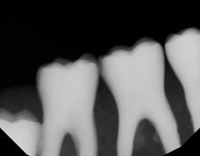 Load image into Gallery viewer, Dexis Titanium Dental Intraoral X-Ray Sensor Size 2
