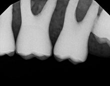 Load image into Gallery viewer, Dexis Titanium Dental Intraoral X-Ray Sensor Size 2

