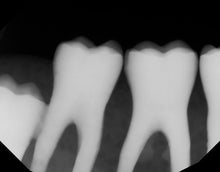 Load image into Gallery viewer, Dexis Ti2 Dental Intraoral X-Ray Sensor Size 2
