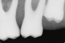 Load image into Gallery viewer, Sirona Schick 33 Dental Intraoral Sensor Kit Size 1
