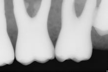 Load image into Gallery viewer, Sirona Schick 33 Dental Intraoral X-Ray Sensor Size 0
