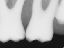 Load image into Gallery viewer, Sirona Schick 33 Dental Intraoral X-Ray Sensor Size 0
