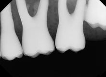 Load image into Gallery viewer, XDR Digital Imaging Intraoral X-Ray Sensor Size 2
