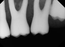 Load image into Gallery viewer, XDR Digital Imaging Intraoral X-Ray Sensor Size 2
