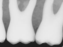 Load image into Gallery viewer, Sirona Schick 33 Dental Intraoral X-Ray Sensor Size 2
