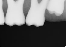 Load image into Gallery viewer, Sirona Schick 33 Dental Intraoral X-Ray Sensor Size 1
