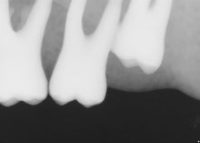 Load image into Gallery viewer, Sirona Schick 33 Dental Intraoral X-Ray Sensor Size 1
