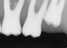 Load image into Gallery viewer, Sirona Schick 33 Dental Intraoral X-Ray Sensor Size 1
