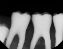 Load image into Gallery viewer, Dexis Titanium Dental Intraoral X-Ray Sensor Size 2
