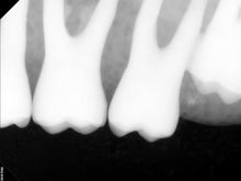 Load image into Gallery viewer, Carestream RVG 6100 Dental Intraoral X-Ray Sensor Size 2
