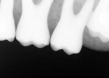 Load image into Gallery viewer, Sirona Schick 33 Dental Intraoral X-Ray Sensor Size 2
