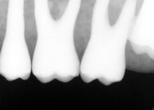 Load image into Gallery viewer, Sirona Schick 33 Dental Intraoral X-Ray Sensor Size 2
