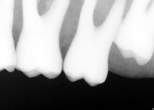 Load image into Gallery viewer, Dentsply Sirona Schick CDR Elite Digital Intraoral Dental X-Ray Sensor Size 1

