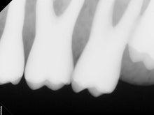 Load image into Gallery viewer, Carestream RVG 6200 Dental Intraoral X-Ray Sensor Size 2
