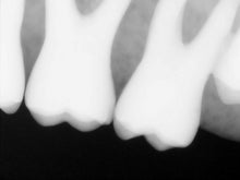 Load image into Gallery viewer, Kodak RVG 6100 Dental Intraoral X-Ray Sensor Size 1
